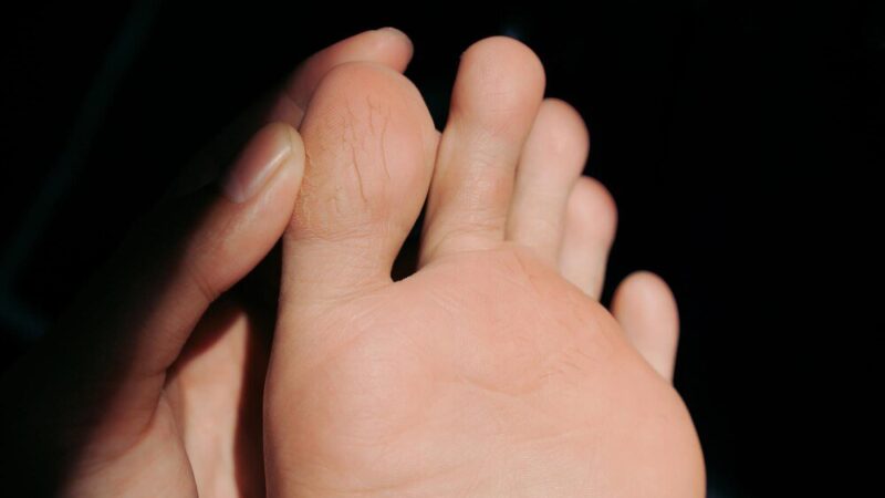 Jak zapobiegać i leczyć odciski na dłoniach podczas treningu siłowego